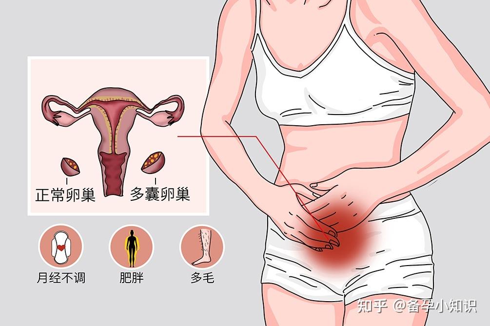 多囊卵巢综合征患者在供卵试管移植后要如何保胎