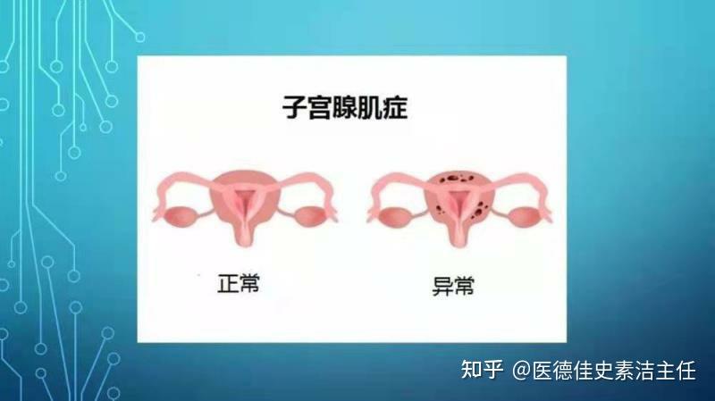 是什么原因导致子宫腺肌症生育困难呢