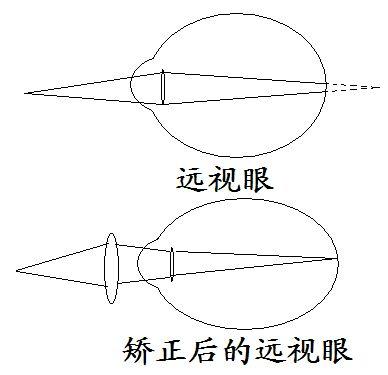 远视眼如何矫正