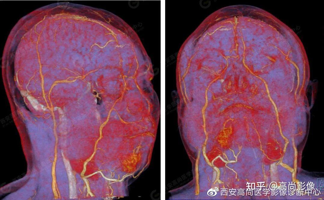 西安高尚病例颌面部血管畸形ctactv成像技术应用