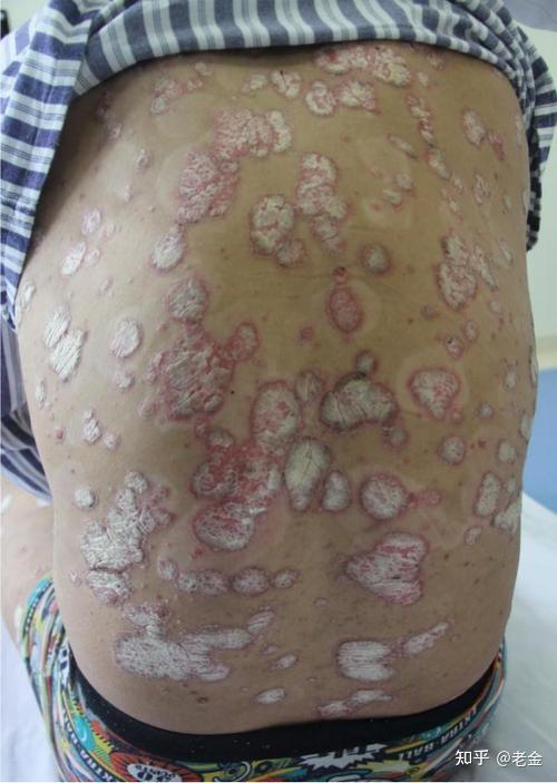 斑块型银屑病 最常见的寻常型银屑病,主要表现为边界清楚的红斑,丘疹