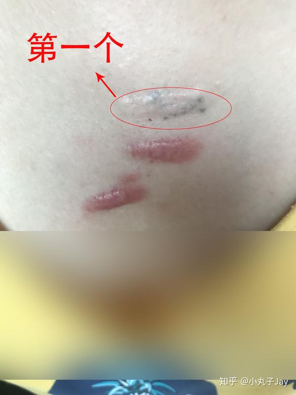 疤痕疙瘩治疗之路