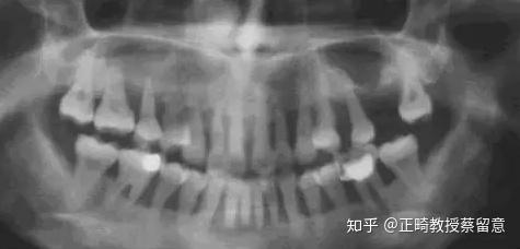 郑州牙齿矫正:牙周炎会偷偷吃掉你的骨头