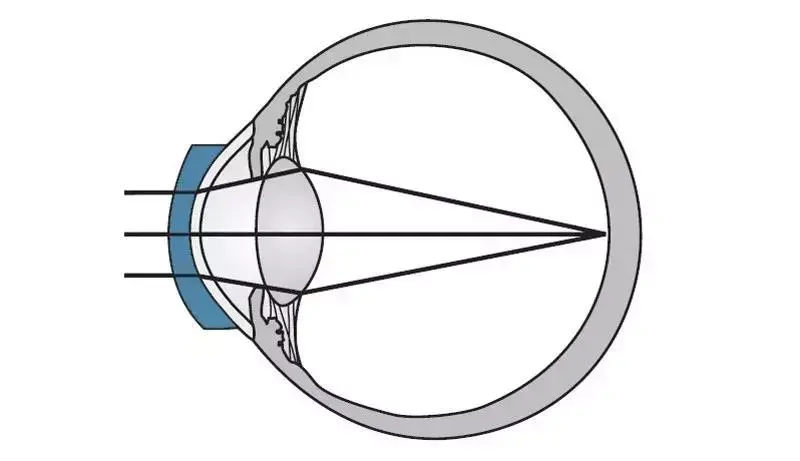 图解秒懂近视矫正方法