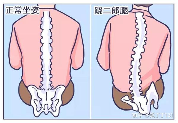 骨盆已经处在变形状态了!