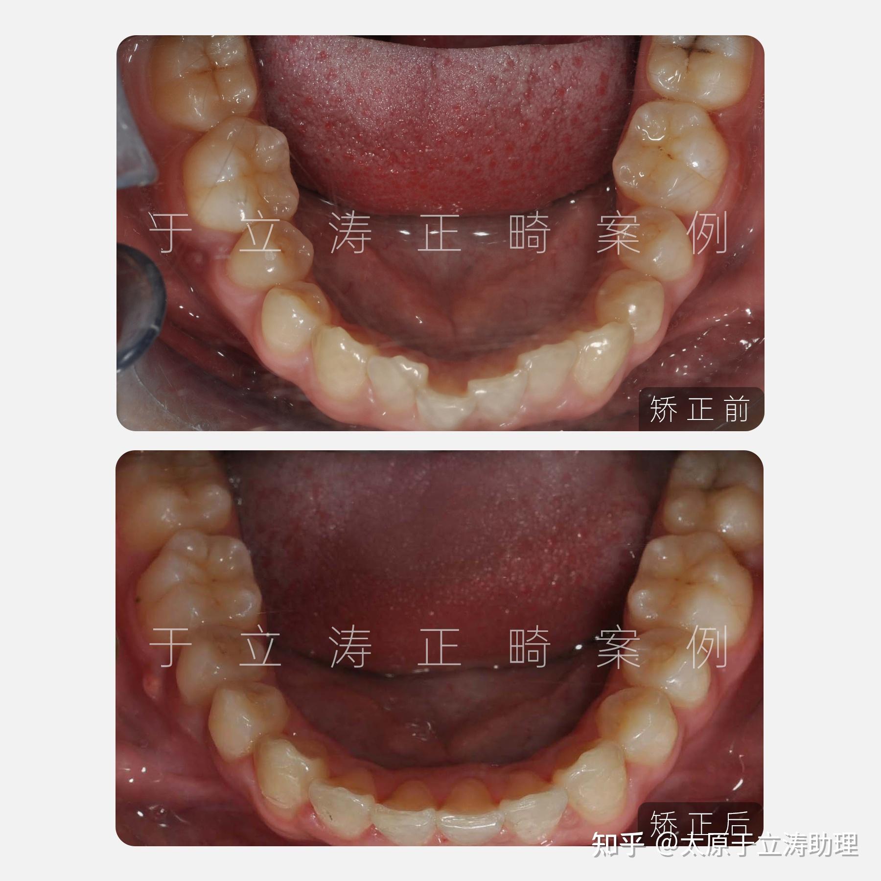 太原牙齿矫正|牙列拥挤 牙齿前突怎么办?