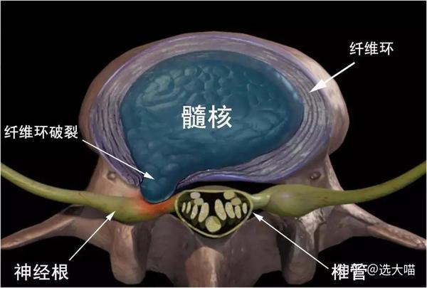 是 因为腰椎间盘各部分(髓核,纤维环及软骨板,尤其是髓核)在 外力作用