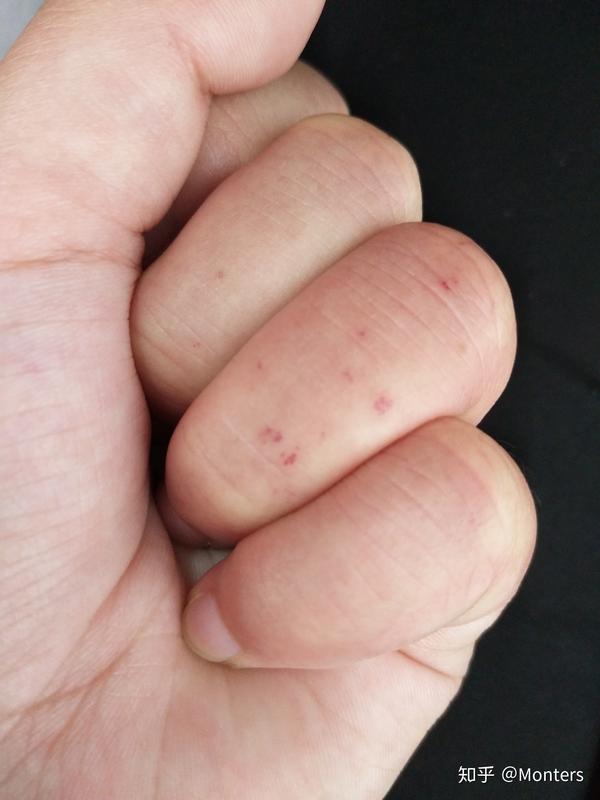 每年都生冻疮,手指长出红色像血点点,是为什么