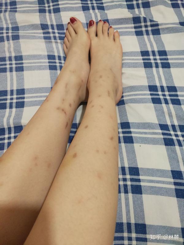然后……高中确诊抑郁症,各种自残划自己就又是一手臂的刀疤