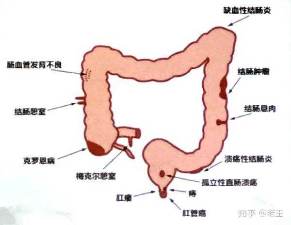 下消化道出血的常见病因