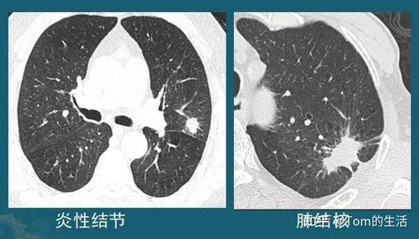 这2种肺结节,极易发展成肺癌!