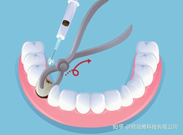 sta无痛麻醉仪真正无痛拔牙