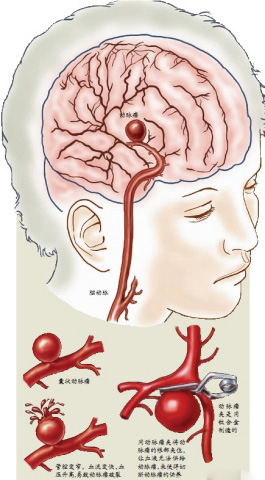 为防止脑动脉瘤破裂造成蛛网膜下腔出血而进行的干预手术(部分保险有
