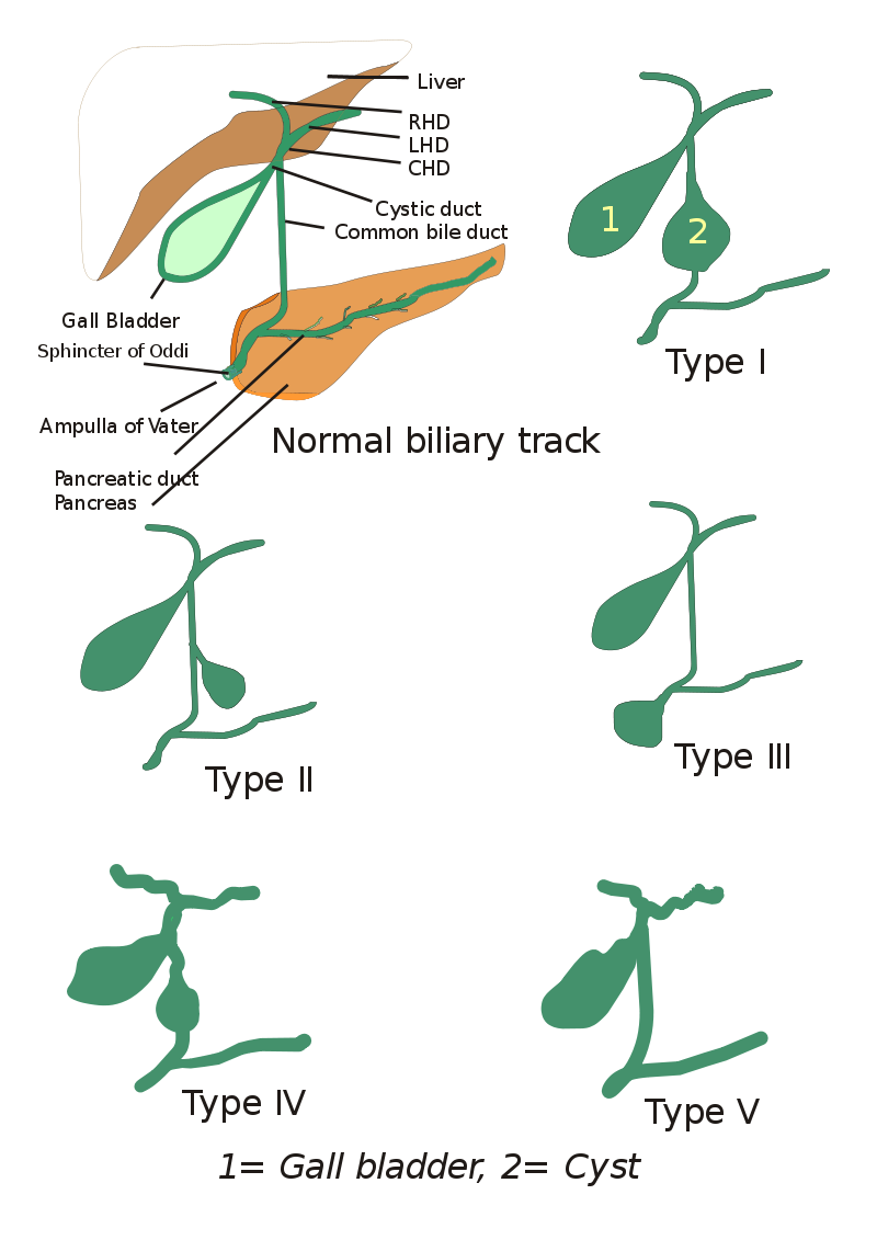 胆总管囊肿 choledochal cysts