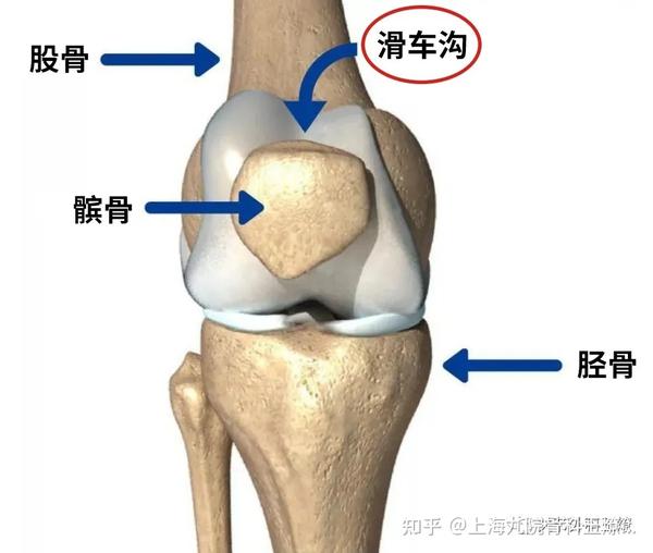 当髌骨因为各种原因偏离了股骨滑车沟 ,就可能出现髌骨脱位的趋势.