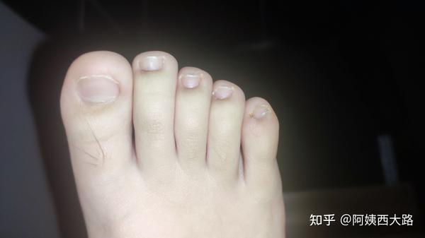 畸形脚指甲恢复过程