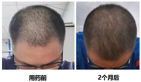 男性雄激素性脱发治疗好方法,请收藏