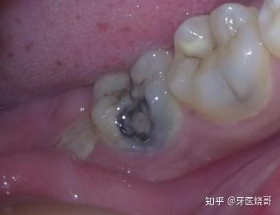 牙齿上出现一个大洞,抽掉牙神经牙齿就死了,这是真的吗?
