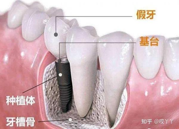 广州圣贝:曾经做过种植牙,现在还可以做牙齿矫正吗?