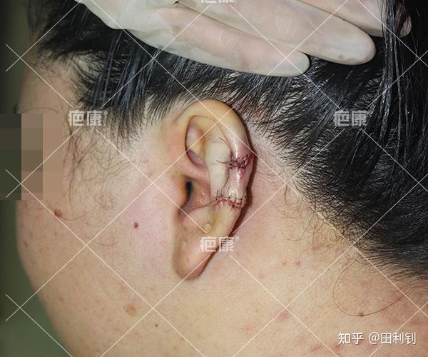 耳朵疤痕疙瘩手术 预防,可以恢复的很好