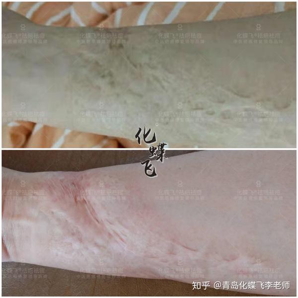 n多年的大面积烫伤疤痕怎么治疗修复?