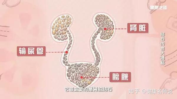 因为输尿管结石,膀胱结石以及下方的尿道结石,大部分都是肾结石掉落