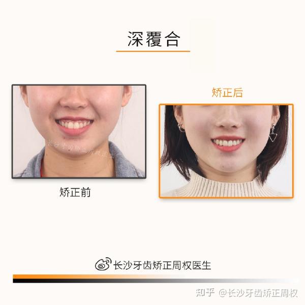 长沙牙齿矫正|正畸合集:牙齿拥挤,龅牙,地包天,深覆合