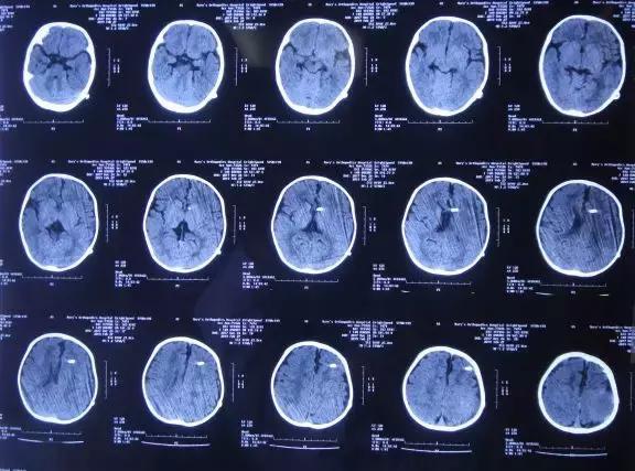 6个月婴儿脑积水头部进行性增大2月余在脑脊液中心79天治愈现在宝宝会
