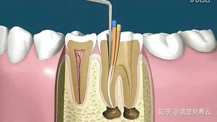 根管治疗?不懂