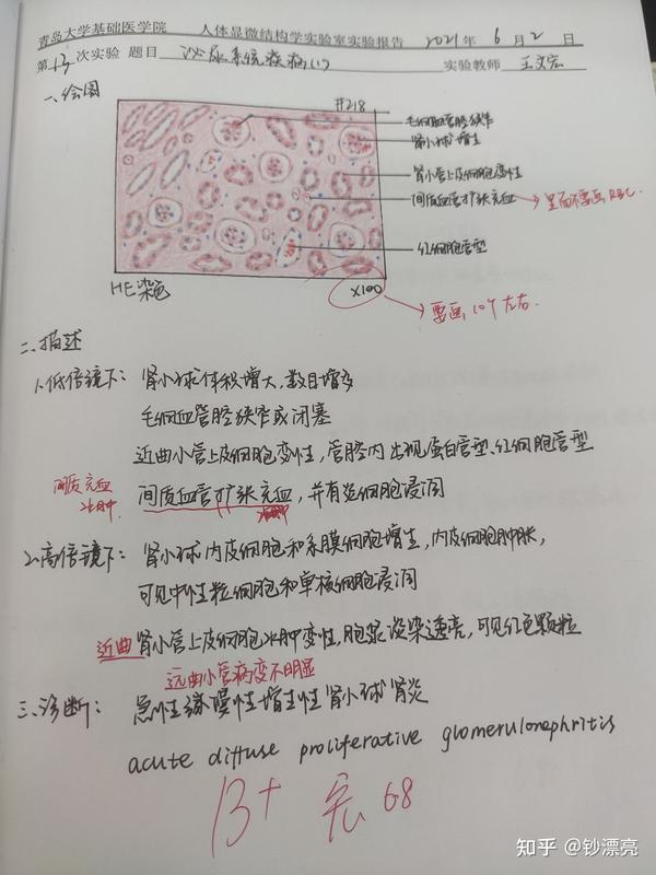 14.慢性肾盂肾炎