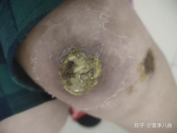 膝盖撞伤,感染发炎,痂下化脓