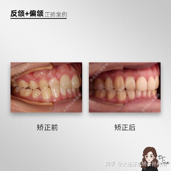 大连牙齿矫正 孙丹阳 案例合辑分享 i 如何在大连找到