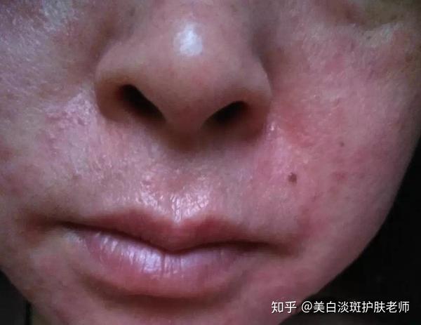 朵嘉浓强强:敏感肌肤面部红斑,痒疹实例分析