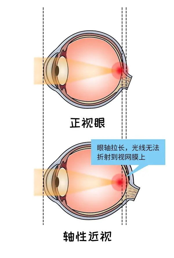 这是最常见的近视,因为眼轴延长,长度超出正常范围,平行光线进入眼内