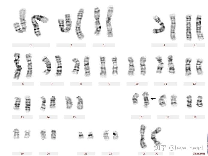 21号染色体短臂随体柄增加)实际工作中遇到的核型图(核型解释在图的