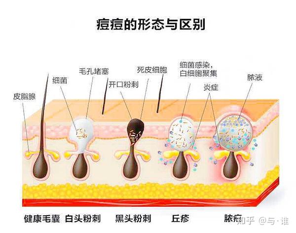 痤疮的发生主要与皮脂分泌过多,毛囊皮脂腺导管堵塞,细菌感染和炎症