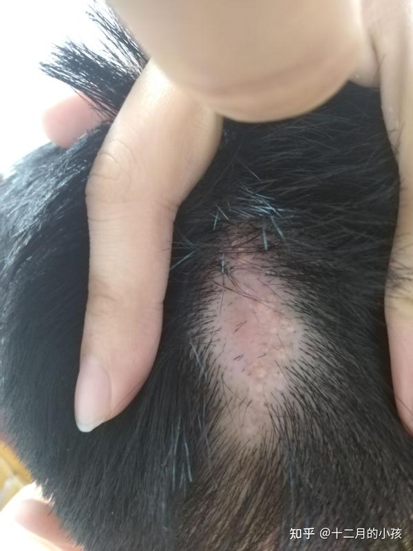 记录一下这一年把26年的皮脂腺痣解决的经历吧多图预警