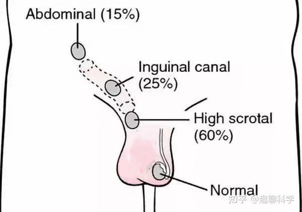 如果下降过程中没有到位,阴囊内并没有睾丸,或者只有一个,也就是隐睾