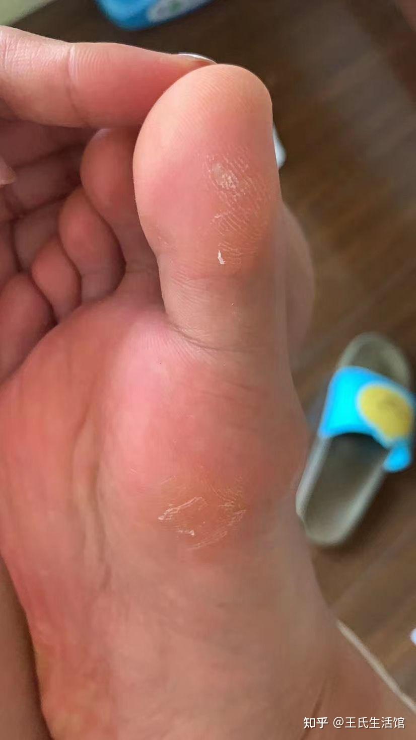 脚底群发跖疣治愈