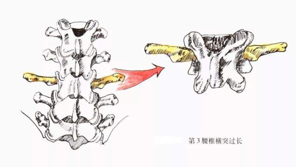 腰疼腰肌劳损可能是腰3横突综合症