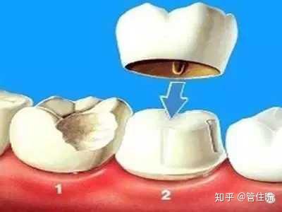 根管治疗后,烤瓷牙套和全瓷牙套的区别在哪里?