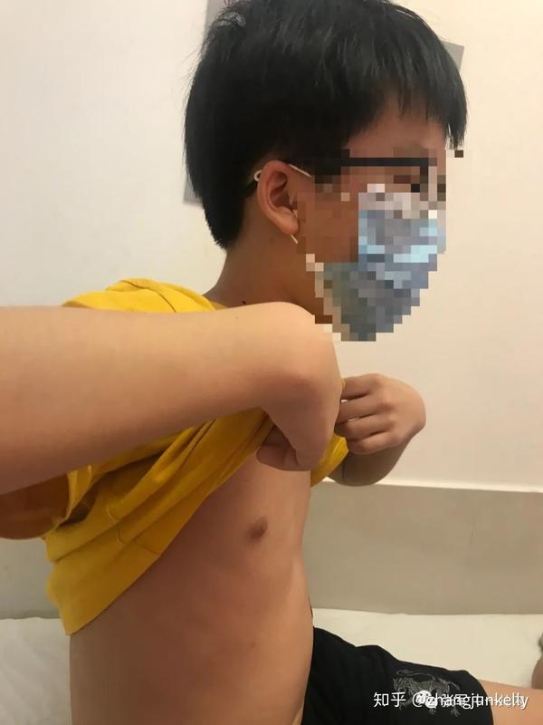 男孩乳房发育不该忽视的现象