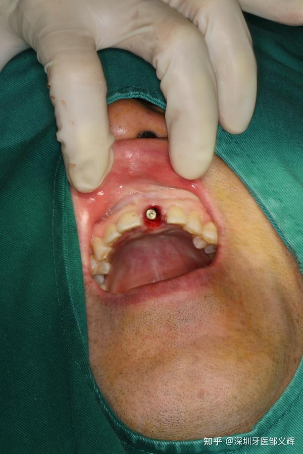 前牙种植即刻修复引导牙龈生长