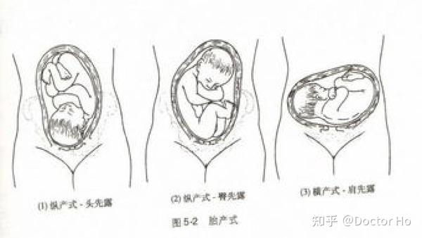 胎先露(fetal presentation) 胎儿最先进入骨盆入口的部位.