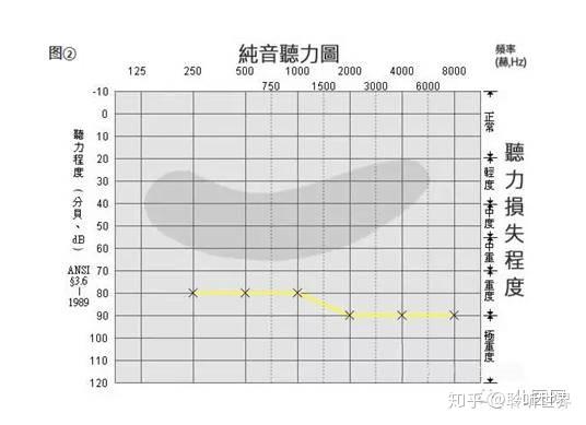 骨,气 若骨,气导均在正常范围以外,且两者分离,此为混合性耳聋,表示