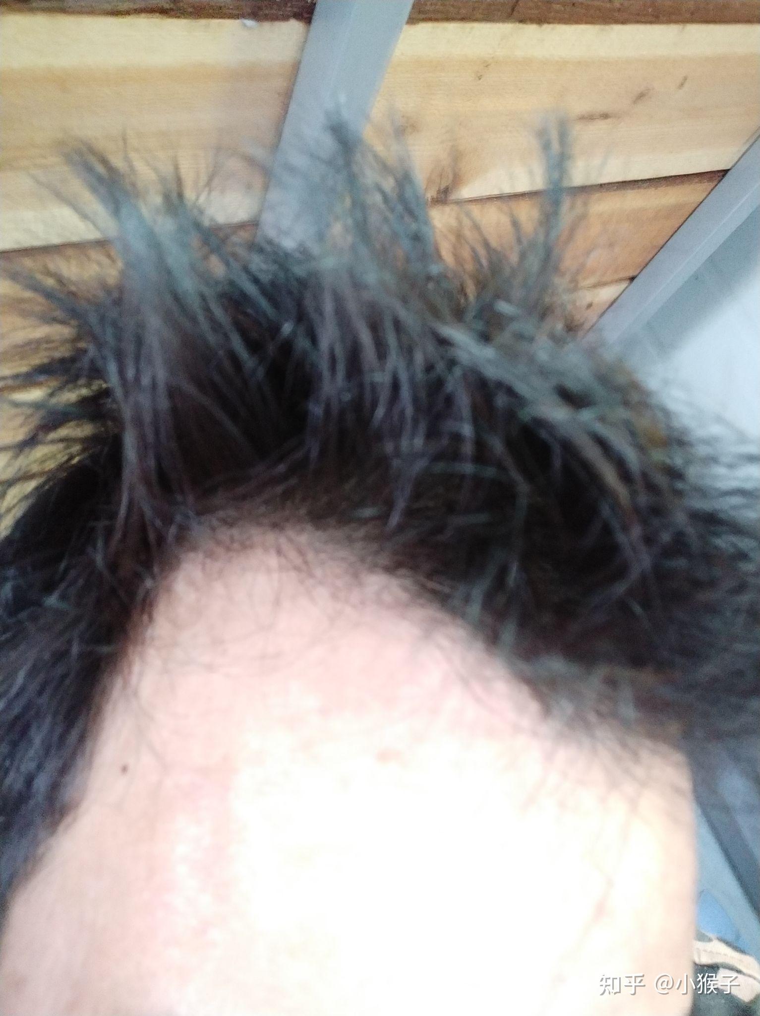 雄激素脱发吃药第二个月