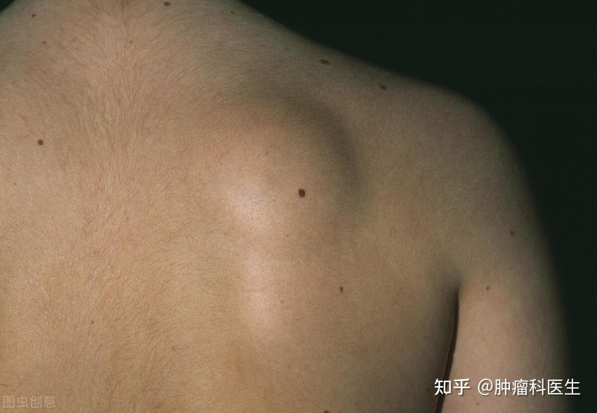 脂肪瘤的典型症状是机体人体脂肪遍布丰富多彩位置,包含颈部,肩背部等