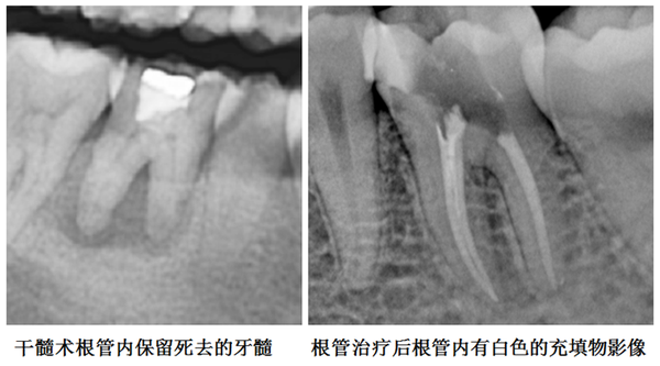 干髓术的适应症比较窄,一般是早期牙髓炎,牙髓尚未坏死且根尖无炎症