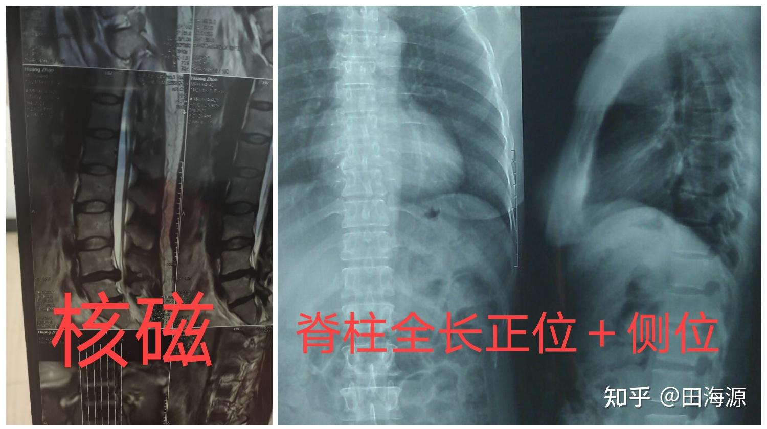 必须拍的片子就是腰椎核磁和脊柱全长x光片正位侧位.