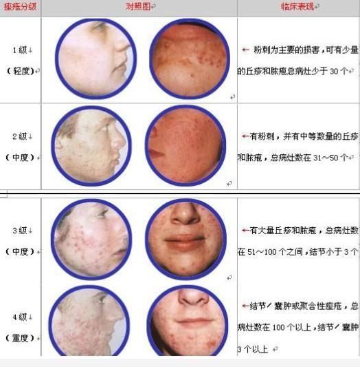 闭合性痤疮的治疗